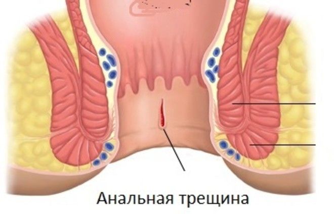 Как выглядит попа после анального Анальная трещина у ребенка: причины и лечение, что делать