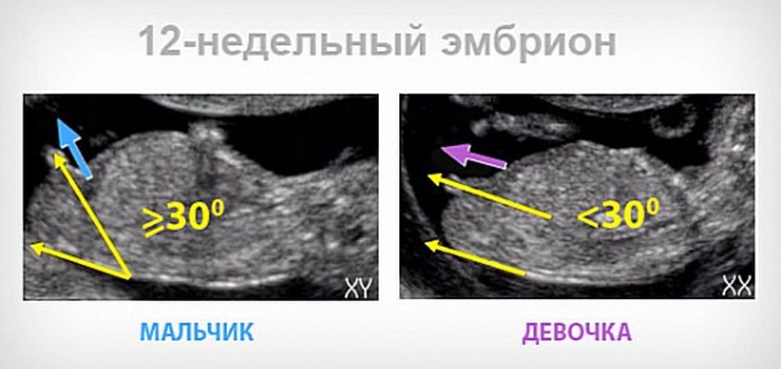 Как определить пол на 20 неделе. Как определить пол на 20 неделе