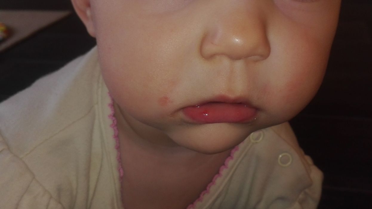 Раздражение возле рта у ребенка 11 месяцев (+ФОТО)