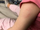 Первый раз реакция на акдс