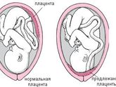 Предлежание плаценты