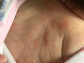 К предыдущему. Аллергия?