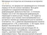 Вальгусная стопа