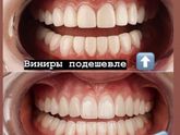 У кого Виниры?покажите