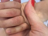 Дерматит у ребёнка чем лечите ?