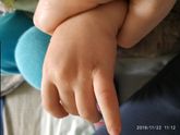У ребенка сыпь Уже