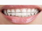 Закрепление зубов после снятия брекет- системы