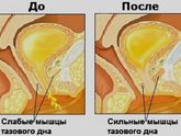 Как использовать вагинальные шарики от недержания?
