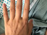 Девочки, я уже писала про отеки пальцев