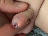Воспаление головки у мальчика