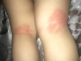 Девочки у ребёнка атомический