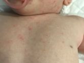 Аллергия или потница ?