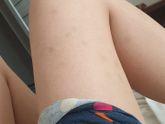 Синяки на ногах