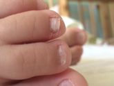 Грибок на ногтях или витаминов не хватает?