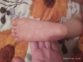 Пятна на стопах у