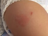 Реакция на Превенар 13