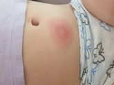 Девочки, ребёнка укусил комар