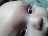 Потничка или аллергия?