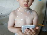 У нас ветрянка
