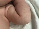 Аллергия или потница ?