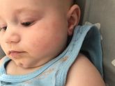 Аллергия, потница или от слюней?