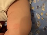 Пятнышко красное, это аллергия?