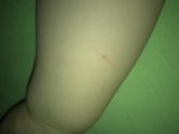 Сегодня сделали манту.