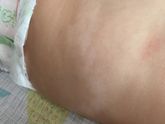 Дерматолог Воронеж и белые пятнышки