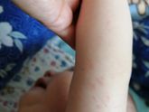 Девочки это аллергия?
