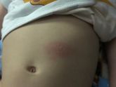 Температура высокая и сыпь