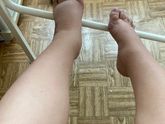 Отеки