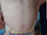 Сегодня вылезло. 10 дней уже принимаем зиртек. Аллергия? Ветрянка? Жду врача