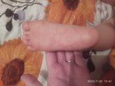 Пятна на стопах у
