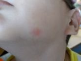 Пятна на теле у ребёнка, похожи на укусы комара