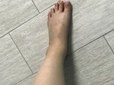 Отеки