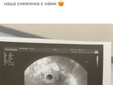21ДПП, УЗИ, плодное яйцо??? Эко