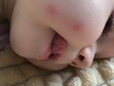 Аллергия или укус ?