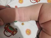 Атопичный дерматит Девочки спасибо вам 🤗💞