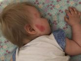 Укусы комаров