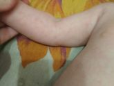 Девочки подскажите аллергия или