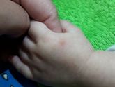 Прыщ на ручке.