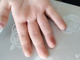 Слезает кожа на пальцах