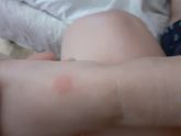 Укусы или алергия