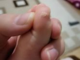Сухая кожа на пальчике