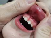 Ребёнок порвал верхнюю уздечку