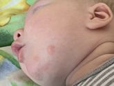 Пятнано и покраснениях на подбородке у грудничка. Переживаю.