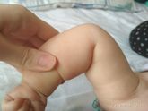 Белое пятно на локте малыша