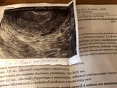 маточная беременность малого срока 2-3 недели от зачатия