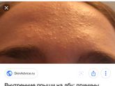 Прыщи на лбу