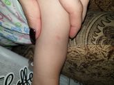На укусы похоже или